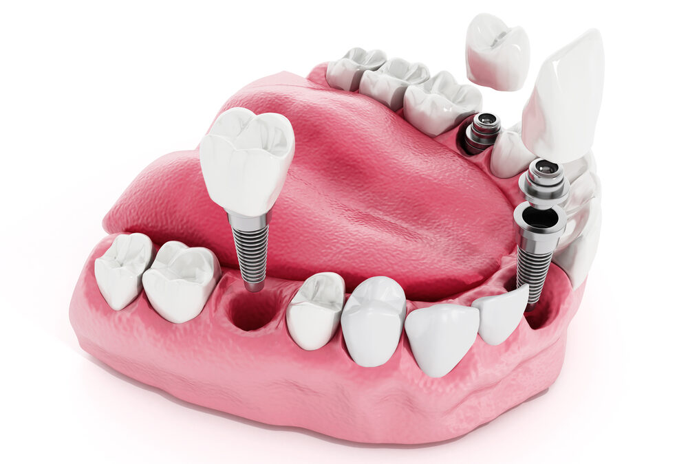 Are Dental Implants Suitable for Children?